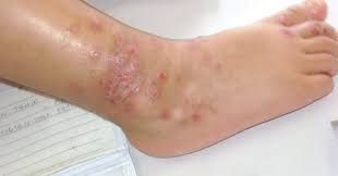 AGEN JUAL OBAT GATAL DI KAKI DAN EKSIM AMPUH DENGAN HARGA MURAH