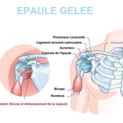 Capsulite rétractile (épaule gelée) : durée, IRM, traitement