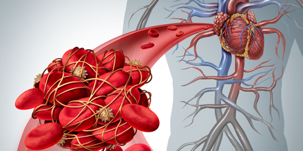 Phlébite (Thrombose veineuse)