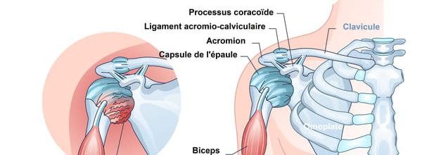 Capsulite rétractile (épaule gelée) : durée, IRM, traitement