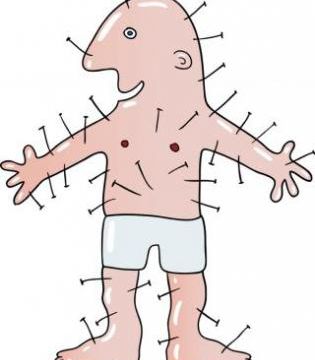 Acupuncture et douleur.