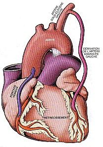 Coronaires, angine de poitrine, infarctus du myocarde.XVI