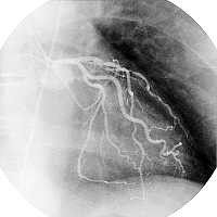 Coronaires, angine de poitrine, infarctus du myocarde.XIV
