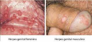 mengobati herpes dengan obat herpes salep di apotik