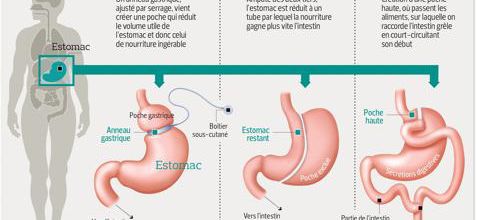 Chirurgie de l’obésité: des interrogations sur le long terme
