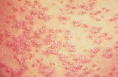 Originie psycologique du psoriasis.
