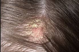 CARA AMPUH MENGOBATI EKSIM DI KEPALA DERMATITIS SEBOROIK