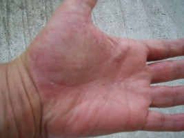 Comment je soigne mon eczéma dyshidrosique des mains ?