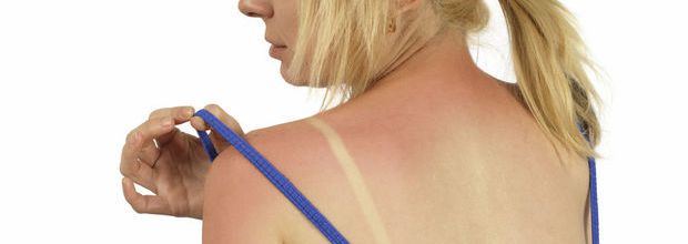 5 produits du quotidien pour soulager vos coups de soleil
