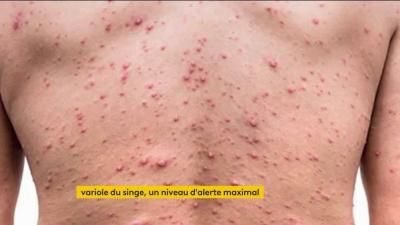 La variole du singe, nouvelle menace d'épidémie.