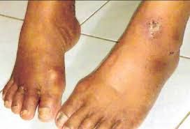 RAMUAN OBAT EKSIM DI KAKI SEMBUH TOTAL SEKALI PENGOBATAN