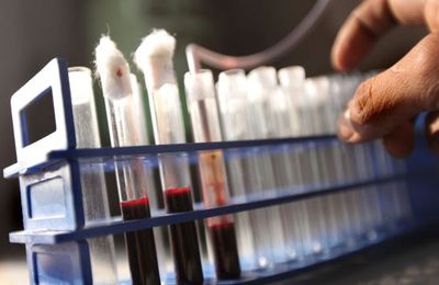 La Belgique en retard en matière de dépistage du VIH-Sida