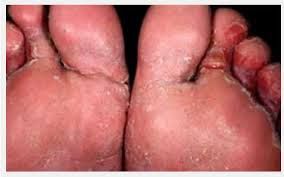 RAMUAN HERBAL OBAT GATAL KAKI DAN EKSIM BUATAN SENDIRI