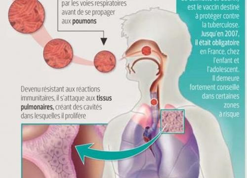 La tuberculose, une maladie encore fréquente