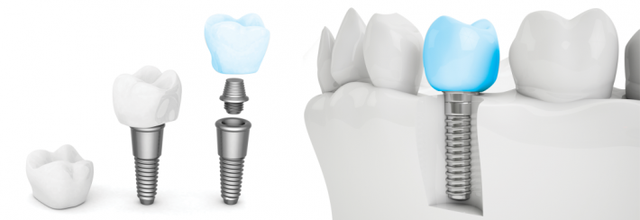 implant