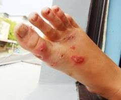 HERBAL ALAMI MENGOBATI EKSIM GATAL - GATAL DI KAKI YANG SELALU KAMBUH