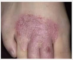 CARA MEMBERANTAS EKSIM GATAL - GATAL DI KAKI 3 HARI SEMBUH TOTAL