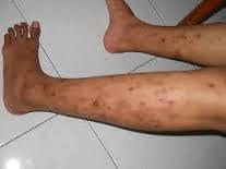 ANTIBIOTIK OBAT GATAL DI KAKI DAN EKSIM RESEP DOKTER YANG MANJUR