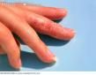 L'eczéma dyshidrosique ou dyshidrose c'est quoi ?