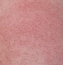 FREESTYLE LIBRE D’ABBOTT : HISTOIRE DE MES MALHEURS