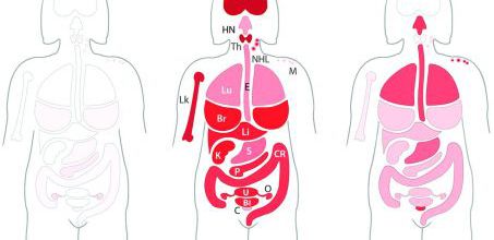 La part du hasard dans les cancers évaluée par une nouvelle étude