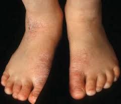 4 BAHAN ALAMI OBAT KAKI GATAL EKSIM MENAHUN PALING AMPUH