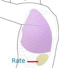 Rupture de la rate