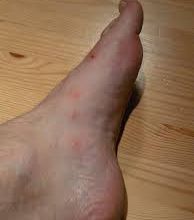 OBAT GATAL DI KAKI SUPER AMPUH DENGAN HARGA MURAH DI APOTIK