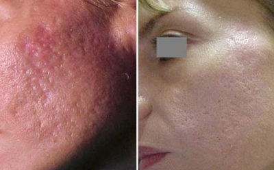 Le traitement de l acne avec un laser. Les avantages et les inconvénients de la therapie au laser