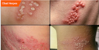 pilihan obat anti virus herpes