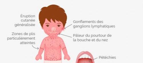 La scarlatine est de retour... 