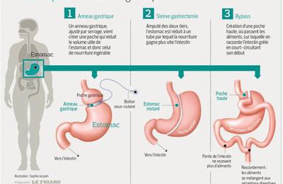 Chirurgie de l’obésité: des interrogations sur le long terme