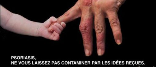 Psoriasis : stop aux idées reçues !