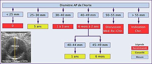 L'anévrisme de l'aorte abdominale