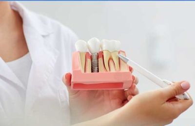 Combien de temps durent les implants dentaires ?