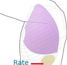 Rupture de la rate
