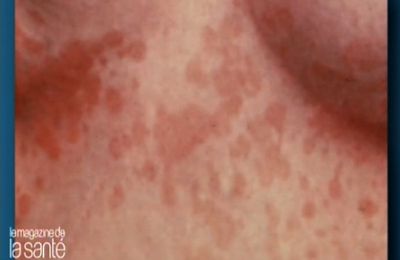 Mycoses de l'été : comment s'en débarrasser