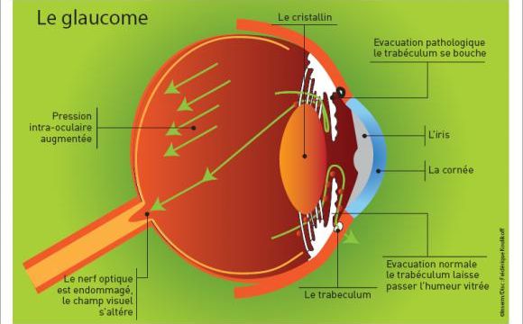 Glaucome et DMLA